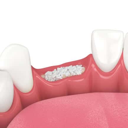 Bone Grafting