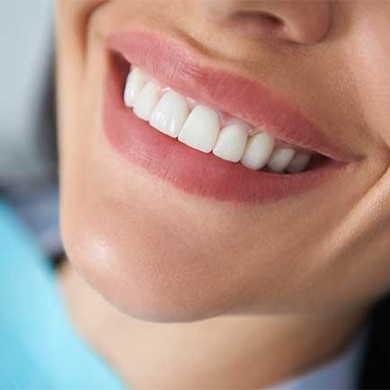 Cosmetic-Bonding