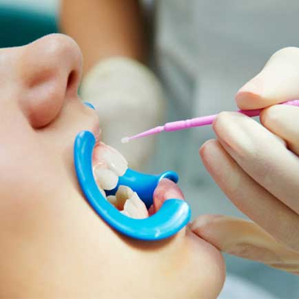 Dental Sealants