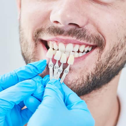 Veneers