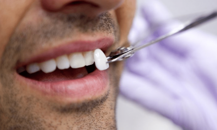 Ways Porcelain Veneers Can Improve Teeth Appearance