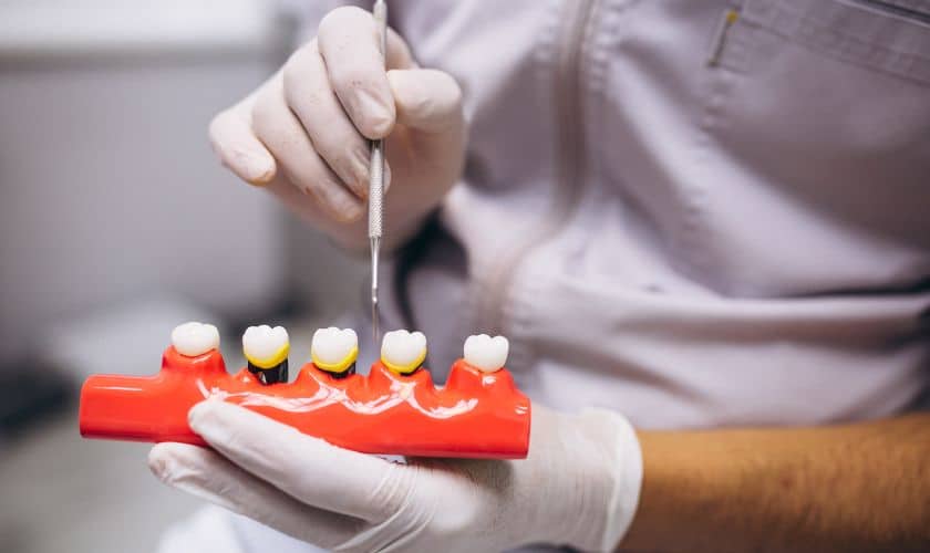 Dental Crowns