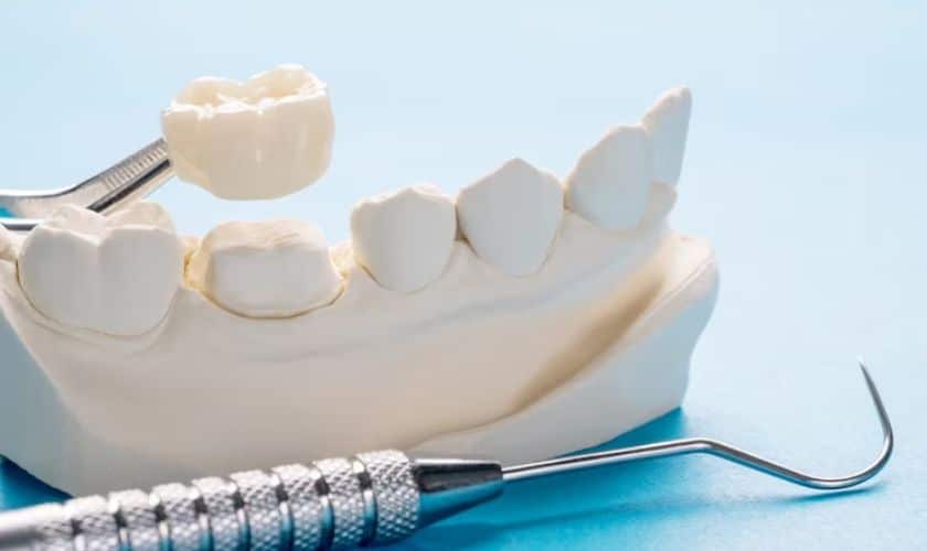 Dental Crowns in Houston