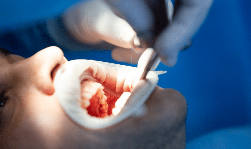 METAL-FREE RESTORATIONS