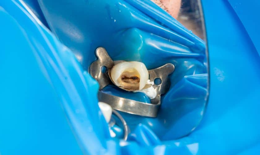 Root Canal Therapy in East Downtown Houston