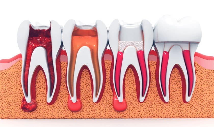 Root Canals in East Downtown Houston