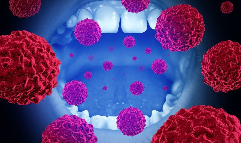 oral cancer in east downtown