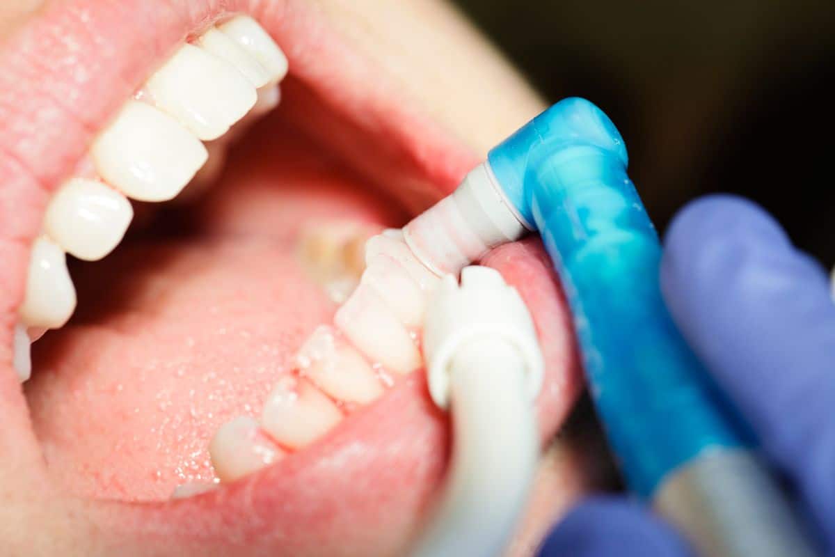 Cosmetic Bonding in Houston, TX