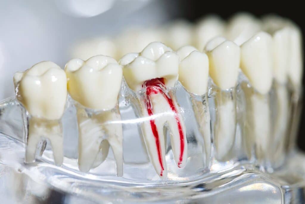 Root Canal Therapy Houston, TX
