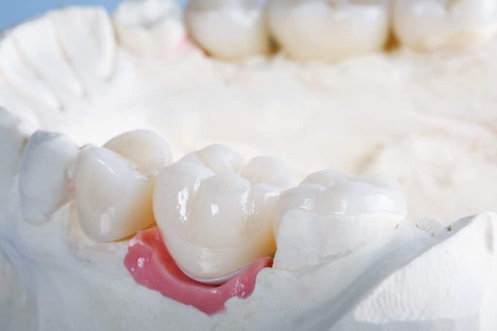 Dental Crowns in East Downtown