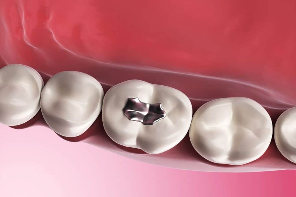 Fillings in Houston
