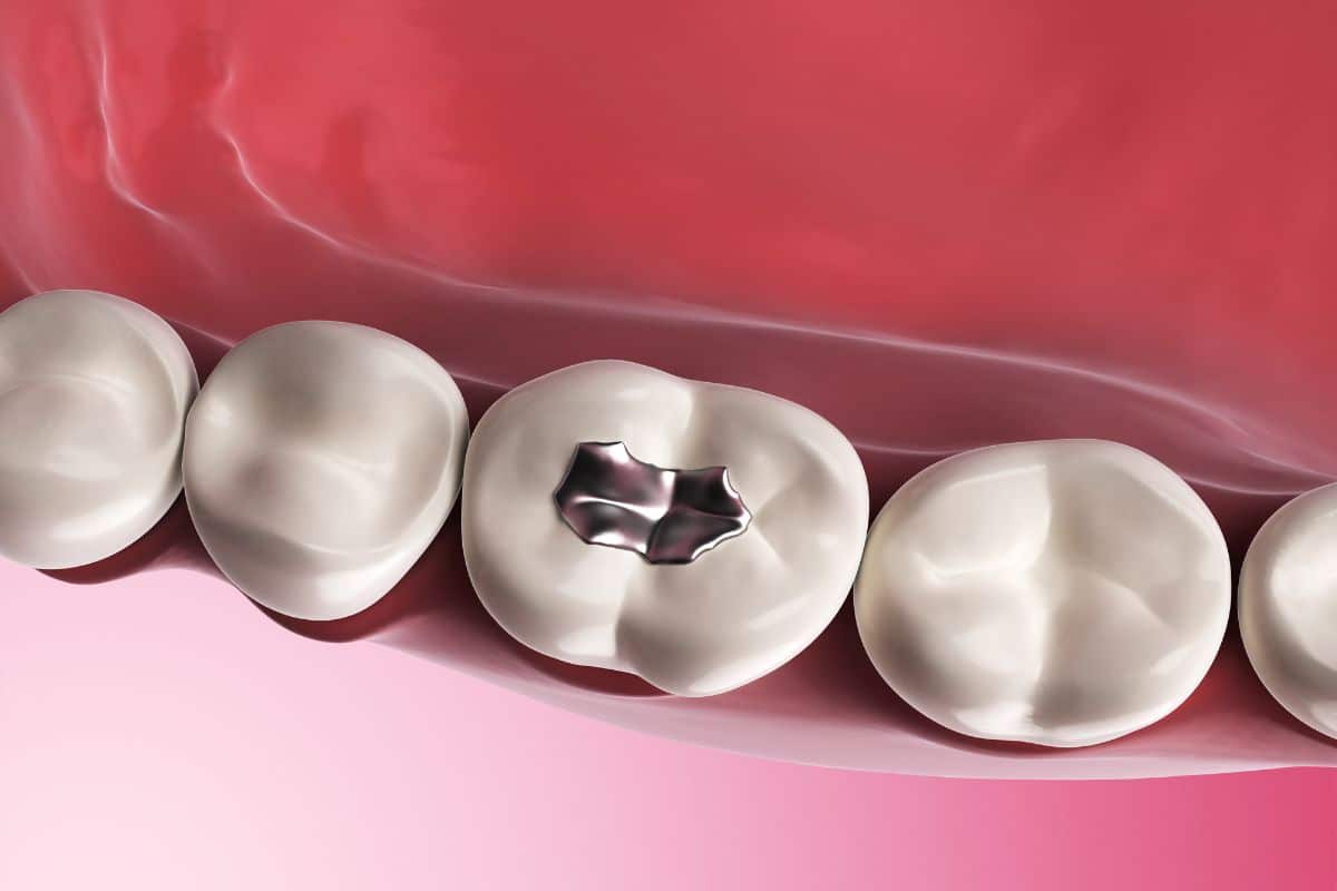 Fillings in Houston