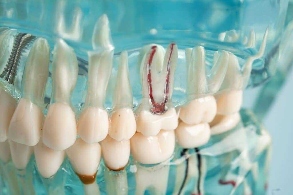 Root Canal Therapy Houston