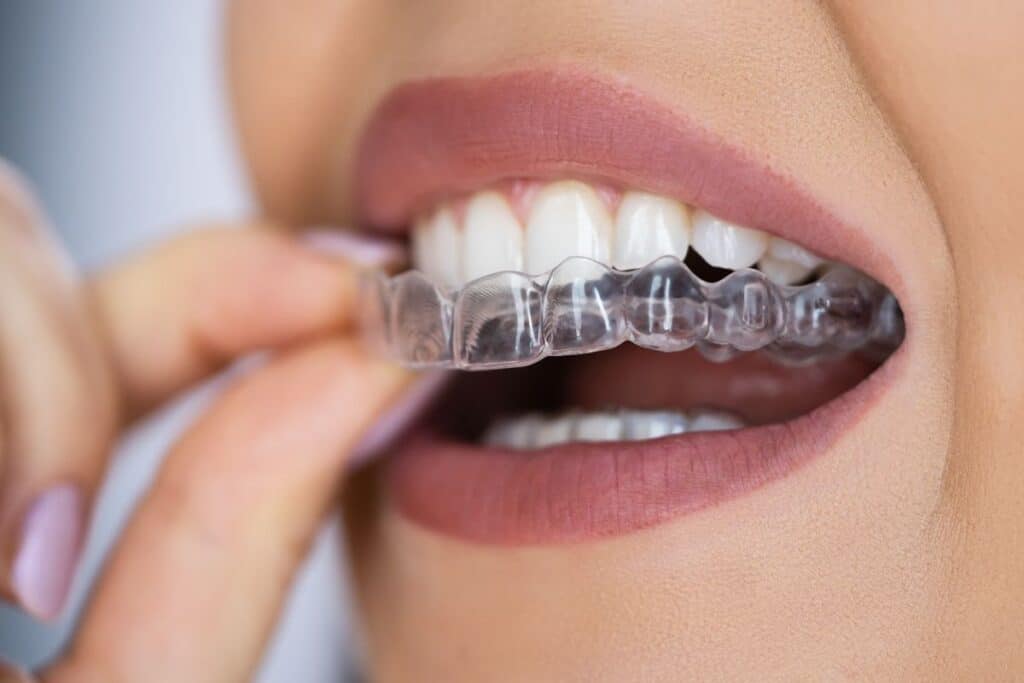 Clear Aligners in East Downtown