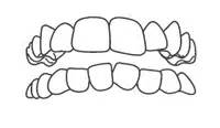 Dental illustration showing upper and lower teeth alignment with hands pointing to proper bite positioning.