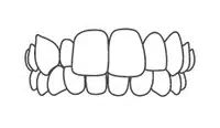 Dental braces or orthodontic appliance showing aligned teeth from frontal view illustration.