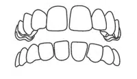 Dental diagram showing upper and lower teeth alignment and bite relationship.