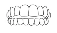 Dental braces or orthodontic appliance shown on upper and lower teeth in side view illustration.