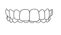 Dental braces or aligners showing upper teeth arrangement in orthodontic treatment diagram.