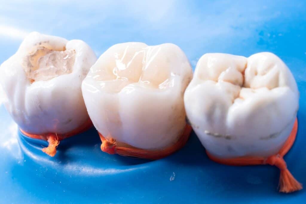 Fillings in Houston