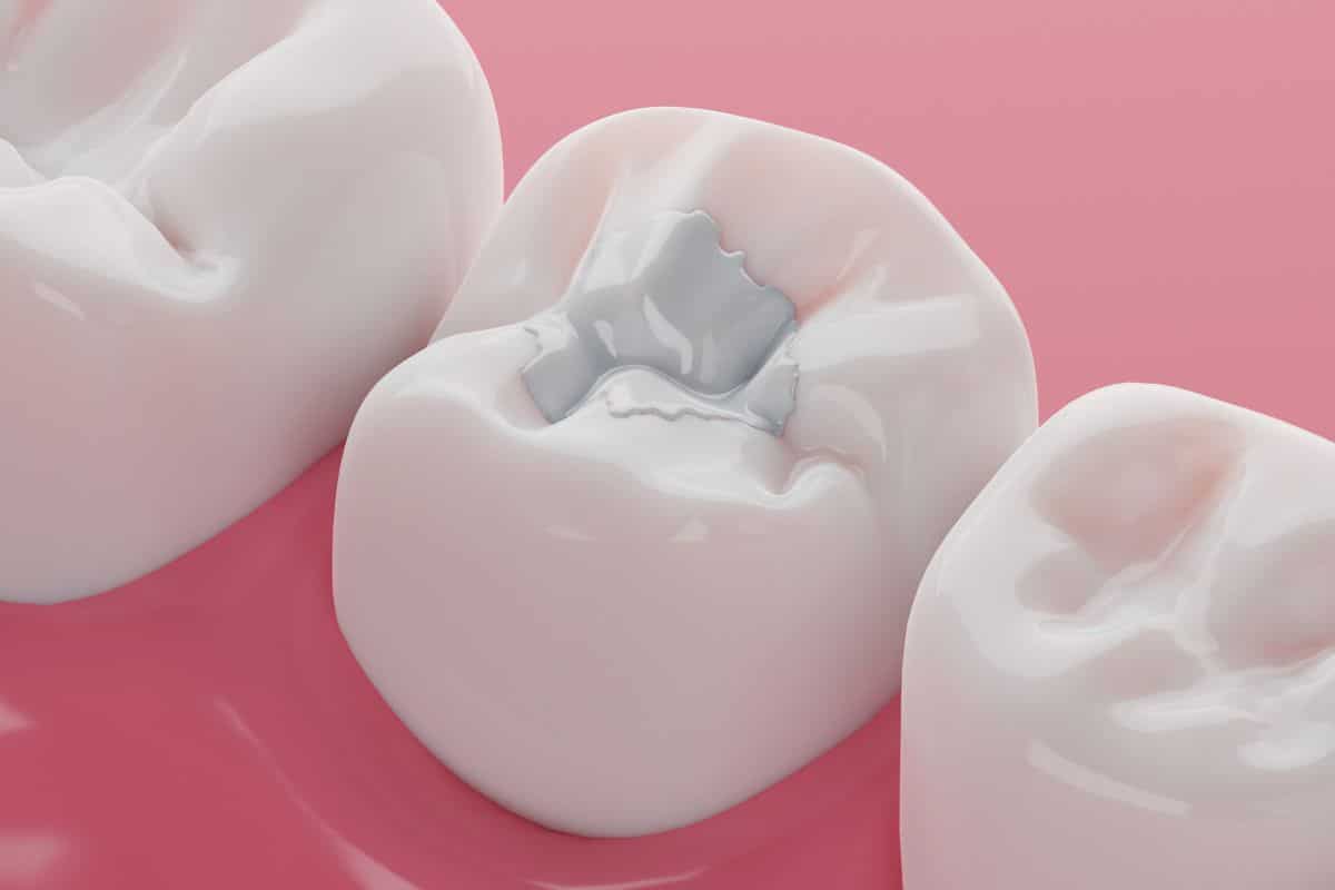 Fillings in Houston