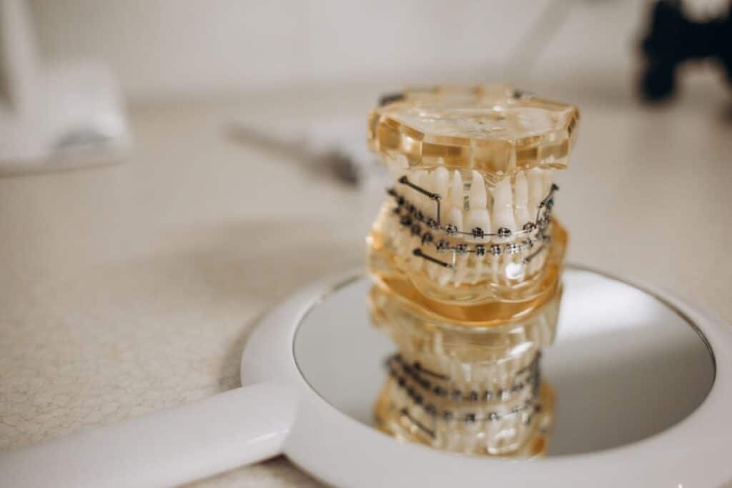 Dental model showing teeth alignment and orthodontic brackets stacked on white plate