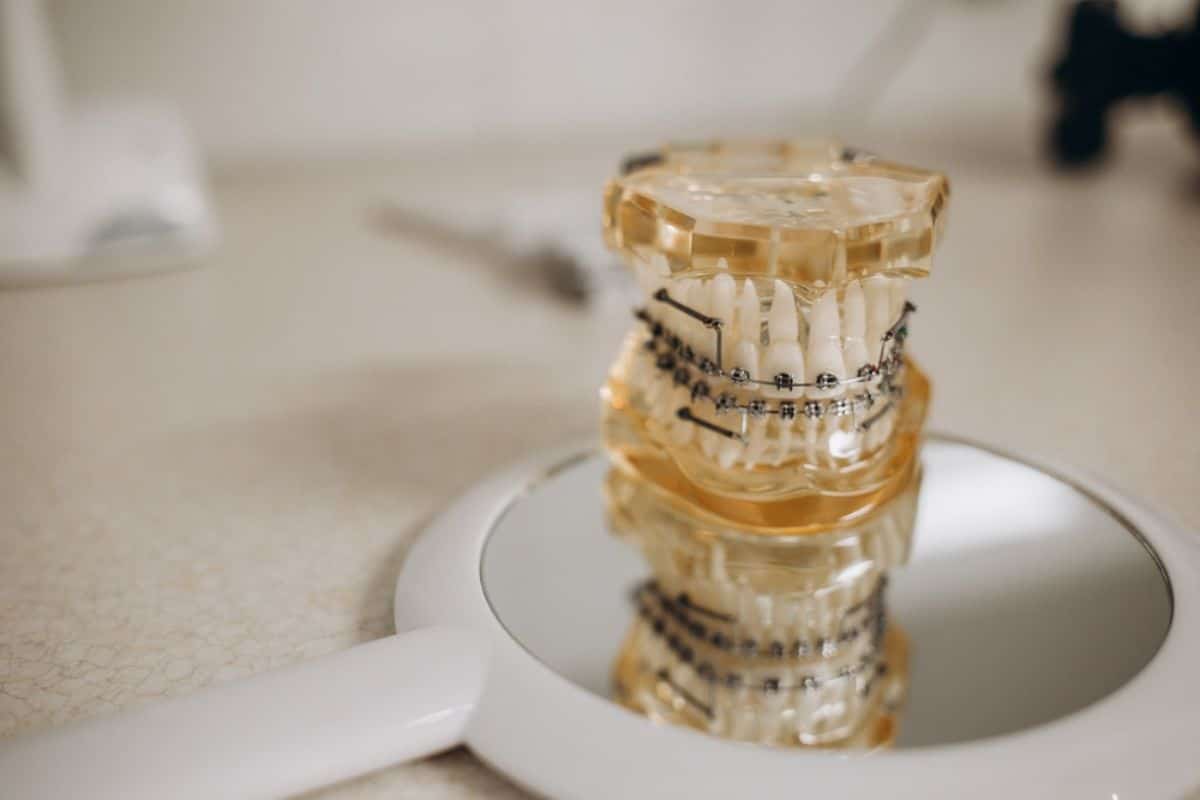 Dental model showing teeth alignment and orthodontic brackets stacked on white plate