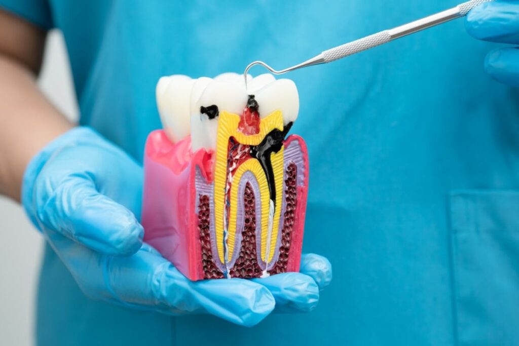 Root Canal Therapy in Houston