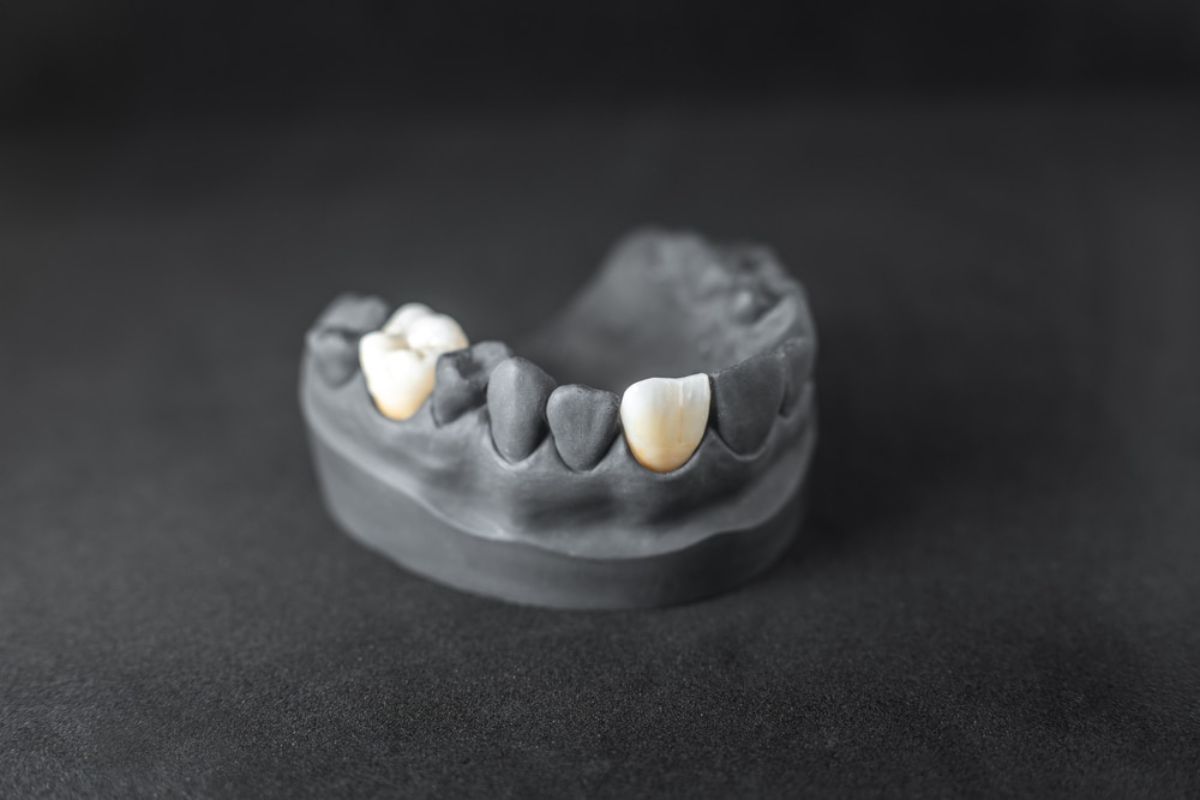 Dental Crowns in East Downtown