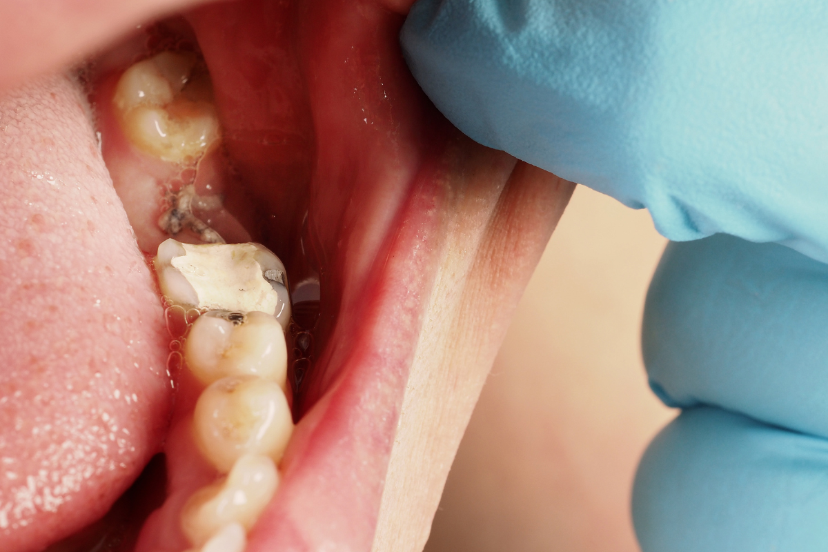 Dental Inlays and Onlays