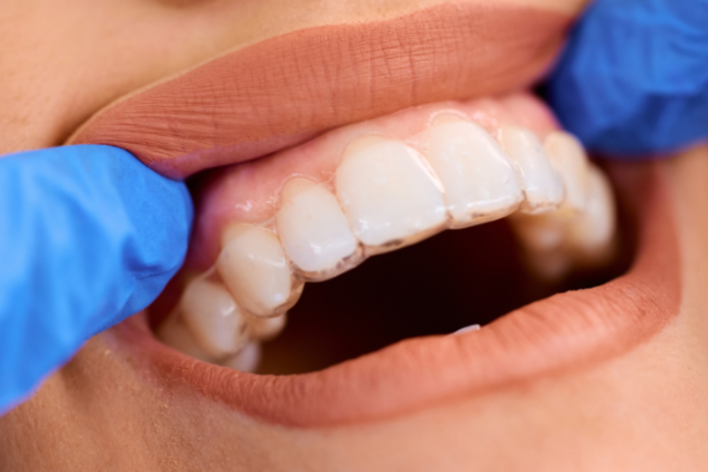 invisalign in East Downtown