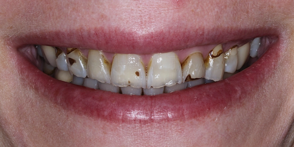 Before - Missing Front Tooth