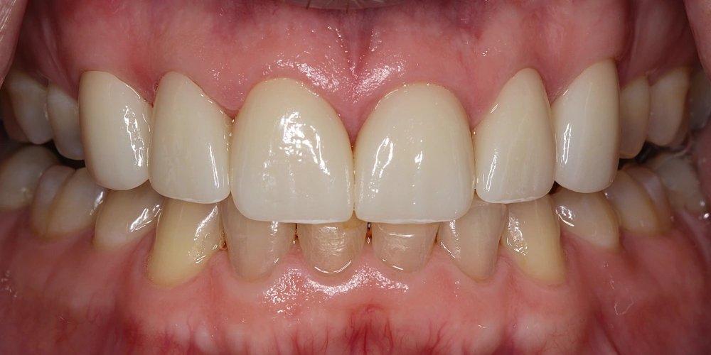 After - Implant Dentures