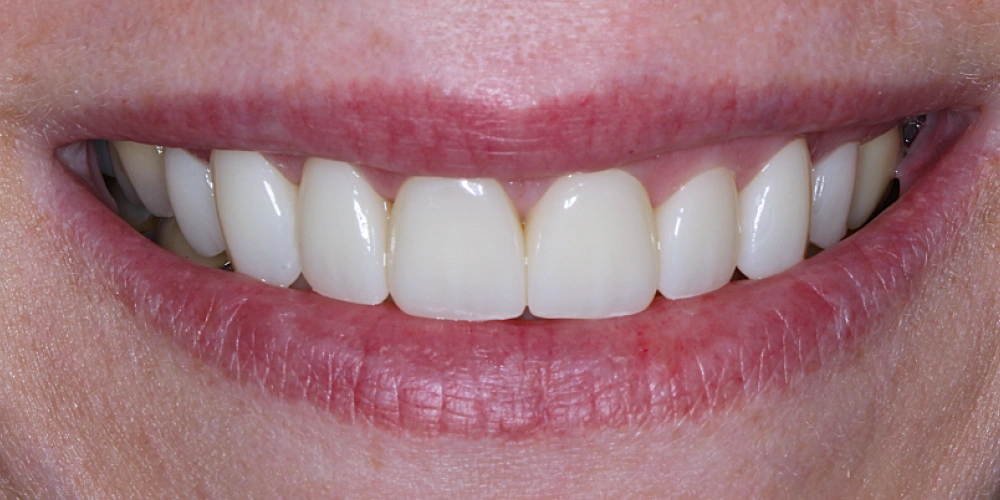 Before - Loose Dentures