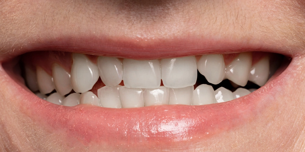 After - Full Mouth