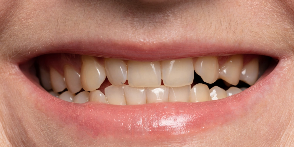 Before - Multiple Missing Teeth